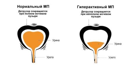 Снижение гипоксии детрузора мочевого пузыря