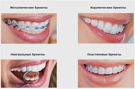 Соблюдение режима ношения брекетов