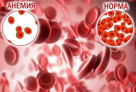 Современные методы лечения анемии у женщин 35 лет