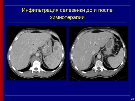 Способы восстановления организма после химиотерапии при лимфоме