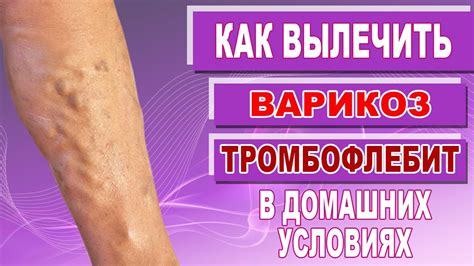 Способы лечения и профилактика закупорки вен