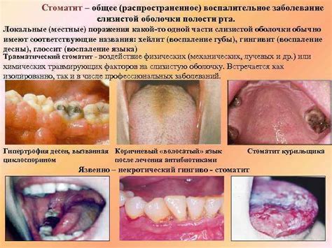 Стоматит - воспалительное заболевание слизистой оболочки полости рта