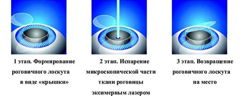 Супер ласик: революционный метод коррекции