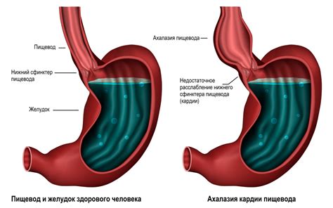 Суть кардии и ее причины