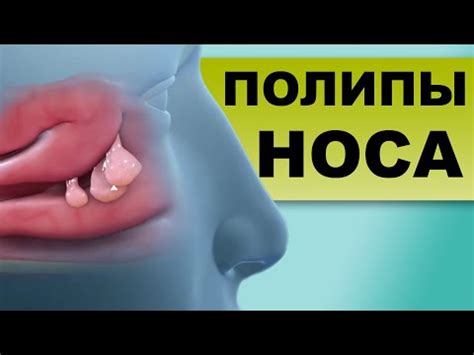 Сушит нос: причины, симптомы, способы