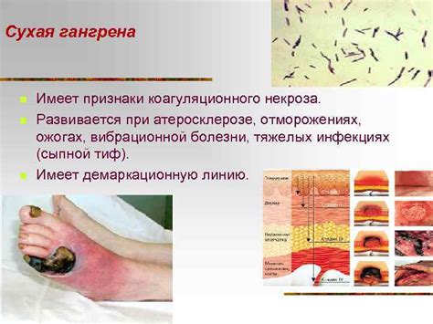 Сходства коагуляционного и колликвационного некроза