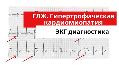 Томография гипертрофии левого желудочка