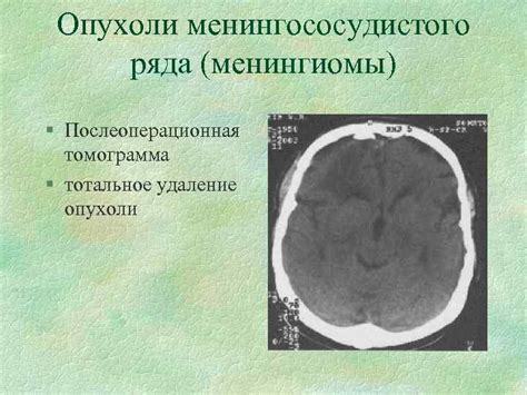 Тотальное удаление опухоли головного мозга: методы и риски