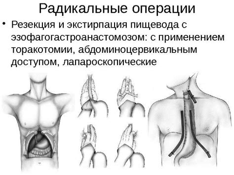 Травмы пищевода