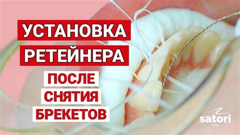 Уделите внимание ретенционной терапии после снятия брекетов