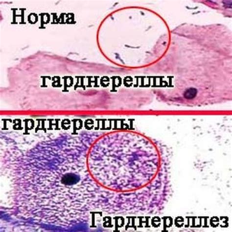 Уреаплазма у женщин: основные признаки и симптомы