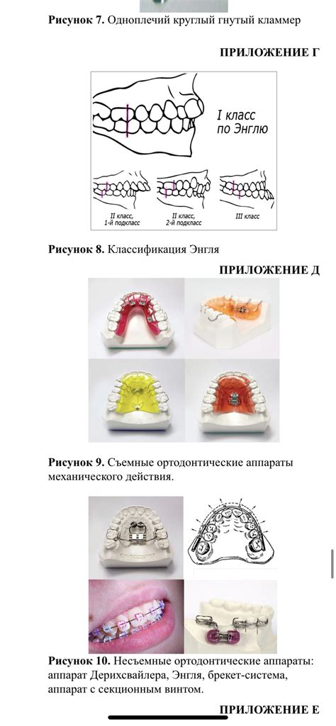 Усиление действия ортодонтического аппарата