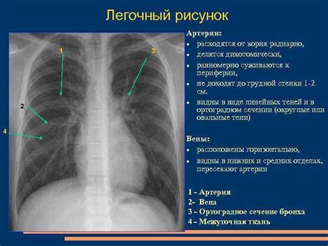 Усиление легочного рисунка на рентгене