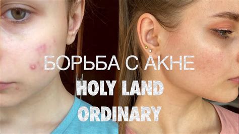 Успешная борьба со воспалениями и акне: Holy land знает, как помочь