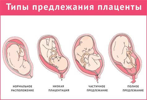 Факторы, влияющие на расположение плаценты