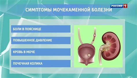 Факторы риска для образования камней в почках