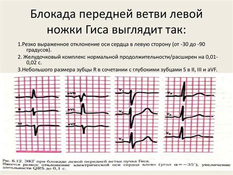 Факторы риска неполной блокады ножки пучка Гиса