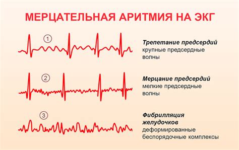 Фибрилляция предсердий и мерцательная аритмия: их сравнение