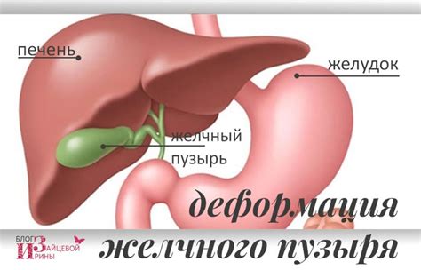 Чем вызвана деформация желчного пузыря?