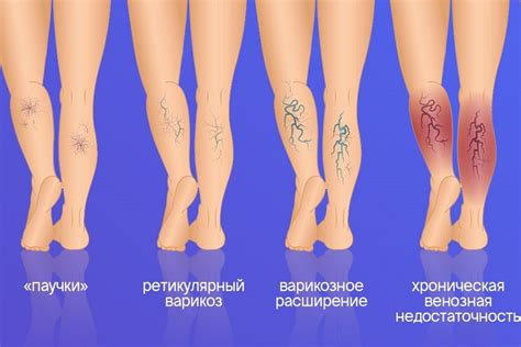 Что делать при наличии варикоза? Главное начать с правильной диагностики