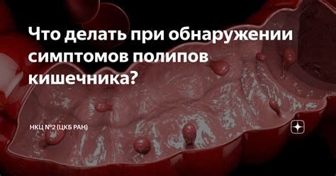 Что делать при обнаружении полипов желчного пузыря?