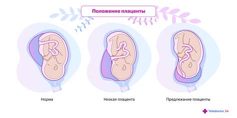 Что значит низкая плацентация на 20 неделе беременности?