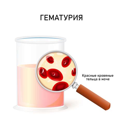 Что означает кровь в моче у ребенка?