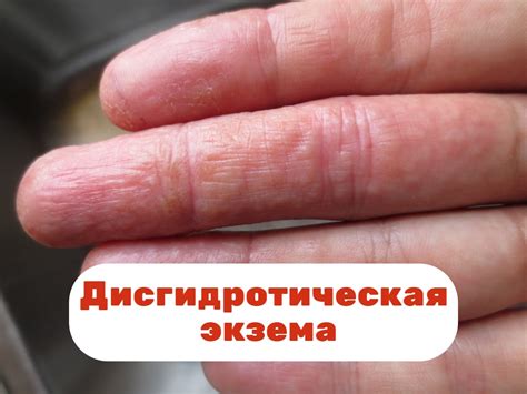 Что происходит, когда подушечки на пальцах рук сморщиваются?