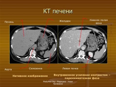 Что происходит во время проведения КТ и КТ с контрастированием?