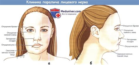 Что происходит при центральном параличе лицевого нерва?