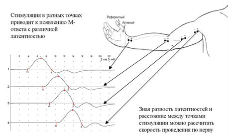 Что такое ЭМГ нервов?