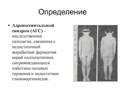 Что такое адрено генитальный синдром у новорожденных?