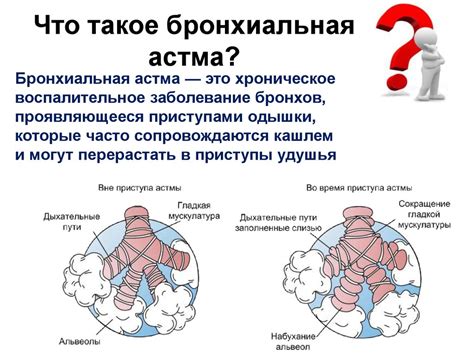 Что такое астма?