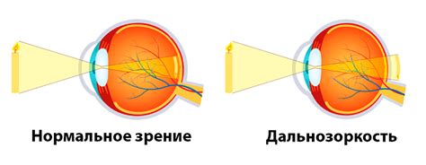 Что такое гиперметропия?