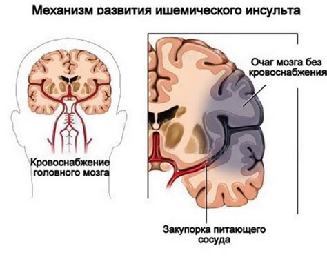 Что такое гипоксия мозга