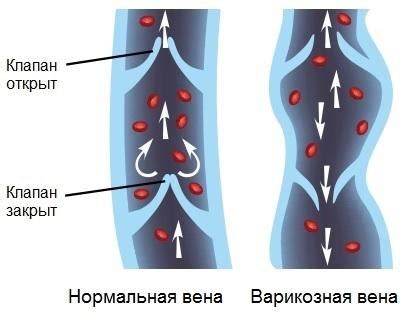 Что такое дилатация вен?