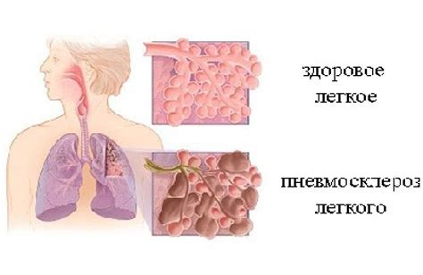 Что такое диффузный пневмосклероз и его возможные осложнения