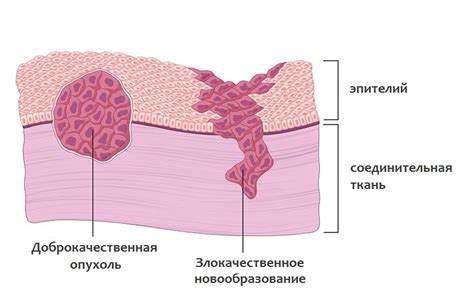 Что такое доброкачественная опухоль?