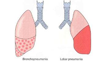 Что такое долевая пневмония?