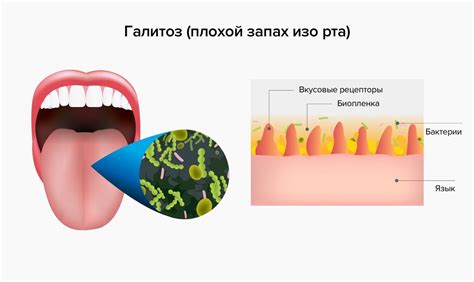 Что такое запах ацетона изо рта и его роль в диагностике заболеваний?