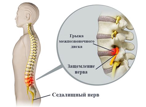 Что такое защемление нерва в позвоночнике?