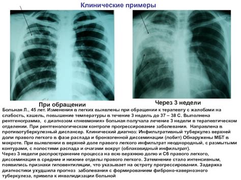 Что такое инфильтрат верхней доли правого легкого?