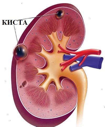 Что такое киста на почке?