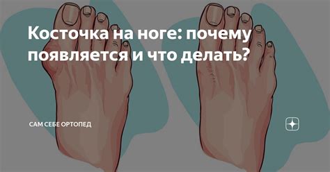 Что такое косточка на ноге?