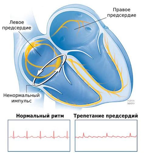 Что такое нарушения левого предсердия?