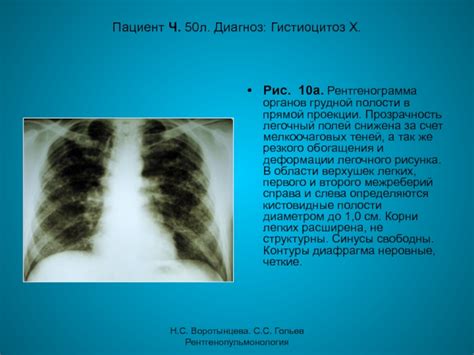 Что такое очаговые инфильтративные изменения в легких?