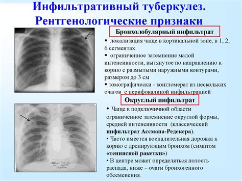 Что такое очаговый пневмонит