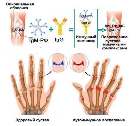 Что такое повышенный ревмофактор?