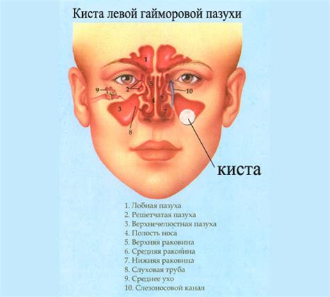 Что такое полипы в верхнечелюстной пазухе?