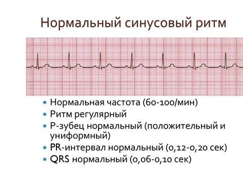 Что такое синусовый нерегулярный ритм с ЧСС?